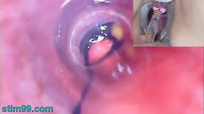 elder doll Peehole Endoscope Camera in Bladder with nut sack